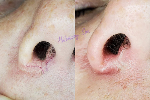 Broken capillaries treated around a nose